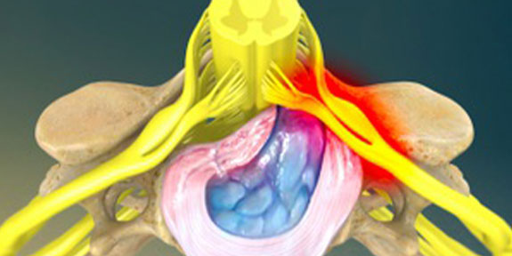 Herniated Disc Buckeye