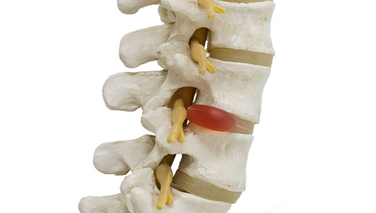 Herniated disc in spine before visiting Phoenix chiropractor