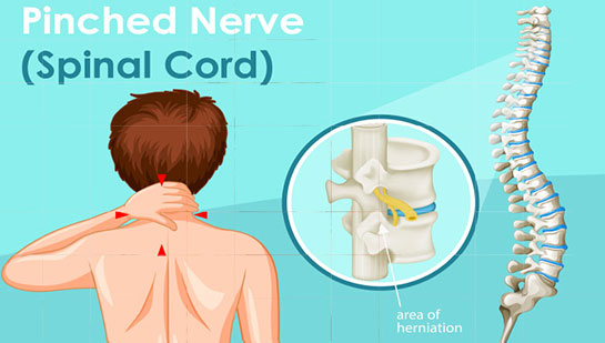 Pinched nerve in spine before chiropractic treatment from Phoenix chiropractor